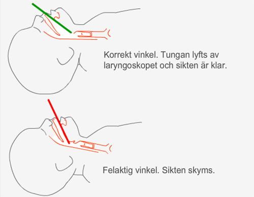 intubation 1